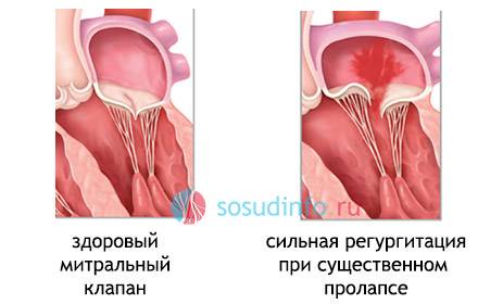 пролапс митрального плапана