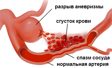 Спазм сосудов