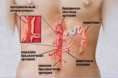 ишемия кишечника