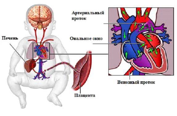 Дырочка в сердце у новорожденного