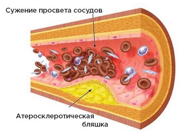 Сужение просвета сосудов атеросклеротической бляшкой