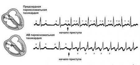 Результаты ЭКГ исследования при разных видах наджелудочковой тахикардии