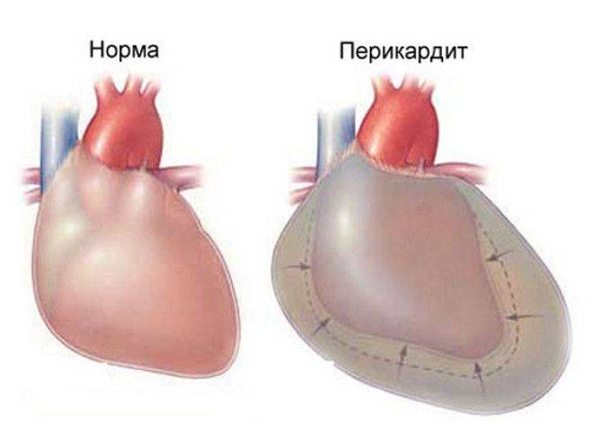 Перикардит