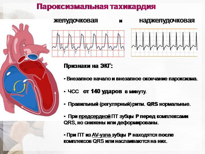 Пароксизмальная тахикардия у детей