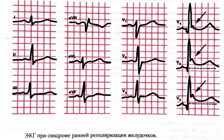 Особенности кардиограмме при этом синдроме