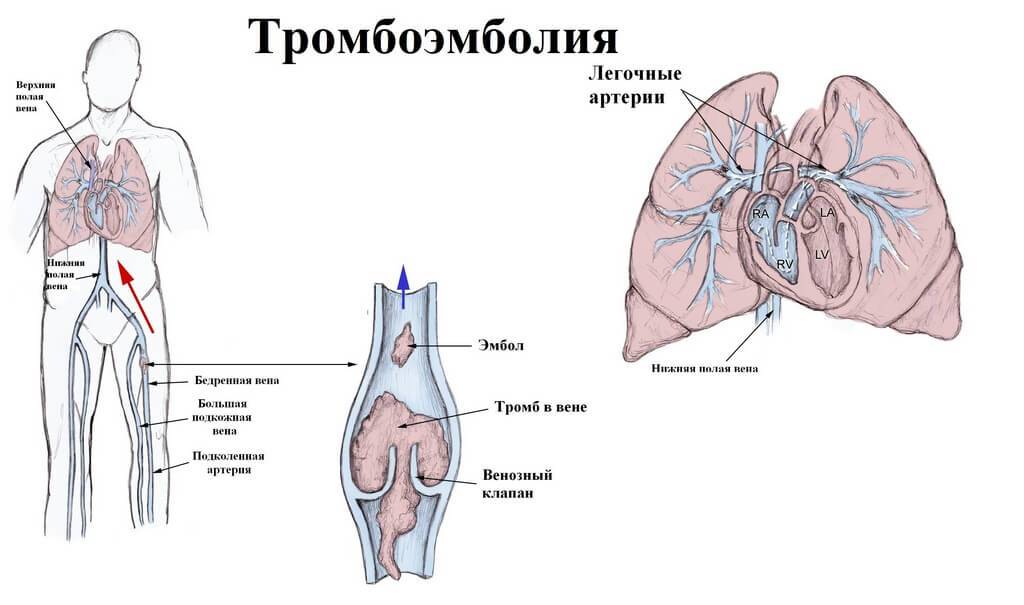 Что такое тромбоэмболия?