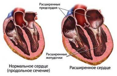 Хроническая сердечная недостаточность: симптомы и лечение