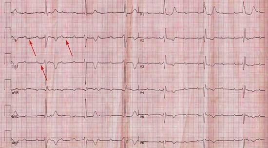 реполяризация на экг
