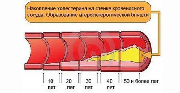 Накопление холестерина