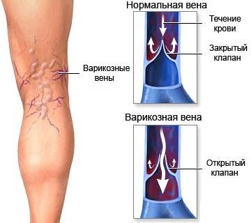 Клапанная недостаточность в венах