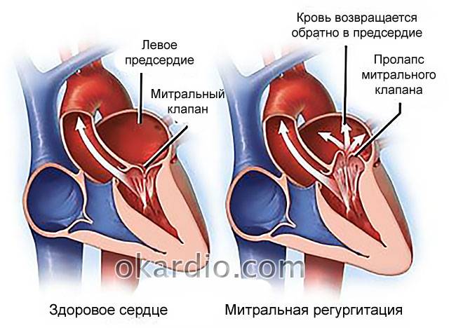 митральная регургитация