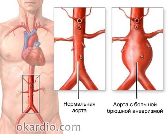 аневризма аорты