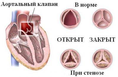 Стеноз