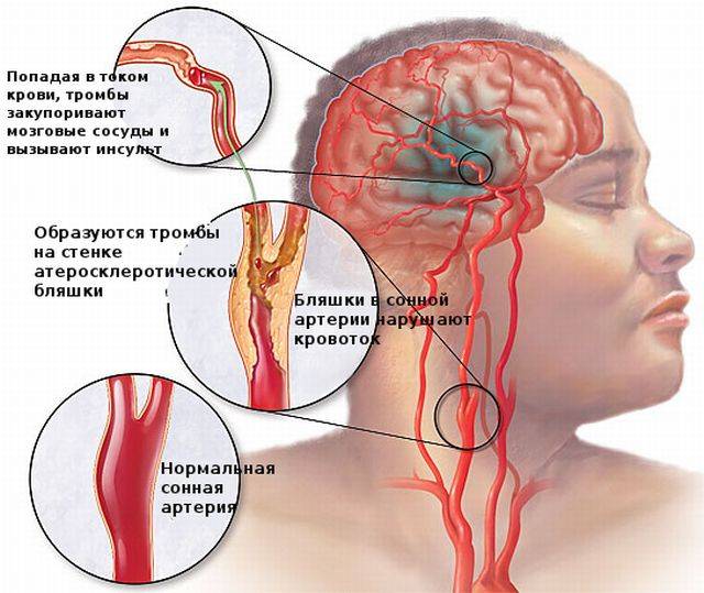 Образование тромбов в головном мозге