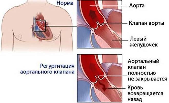 Митральная регургитация 1 степени