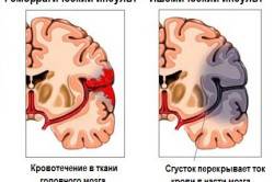 Формы обширного инсульта