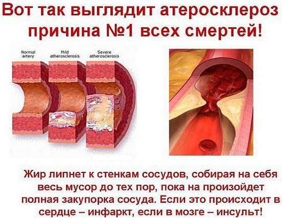 атеросклероз