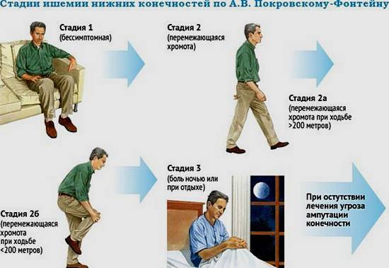 симптомы атеросклероза нижних конечностей