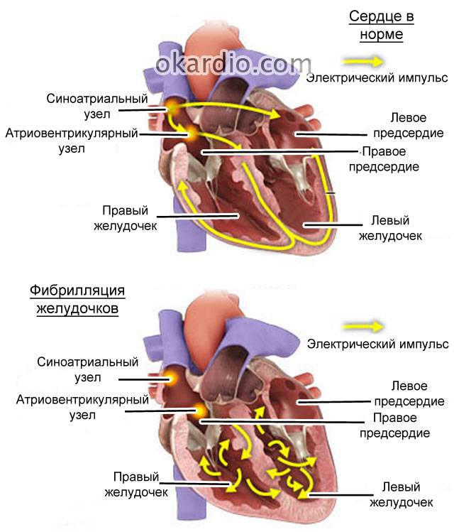 фибрилляция желудочков