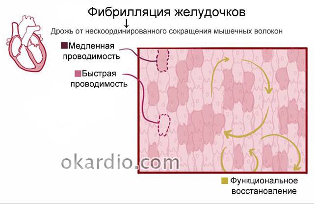 фибрилляция желудочков
