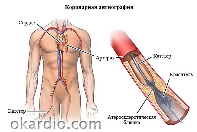 коронарография