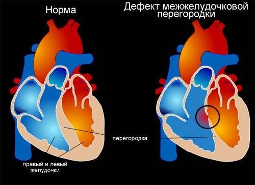 дефект межжелудочковой перегородки