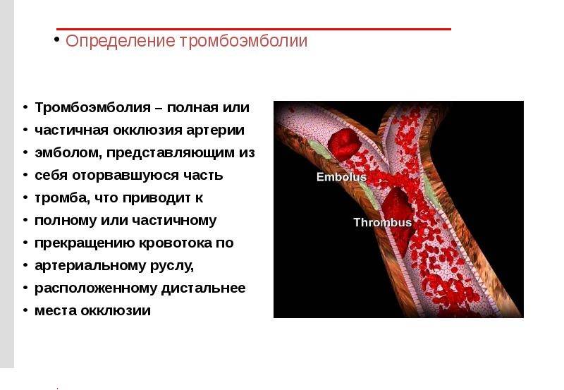 Тромбоэмболия