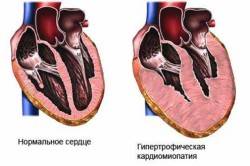 Схема концентрической гипертрофии миокарда