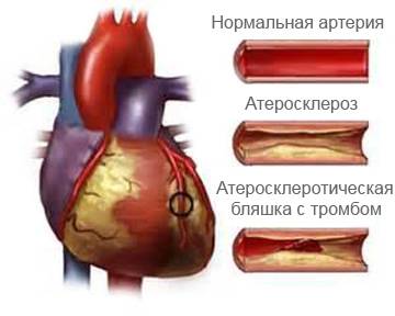 Атеросклероз как основная причина болезни
