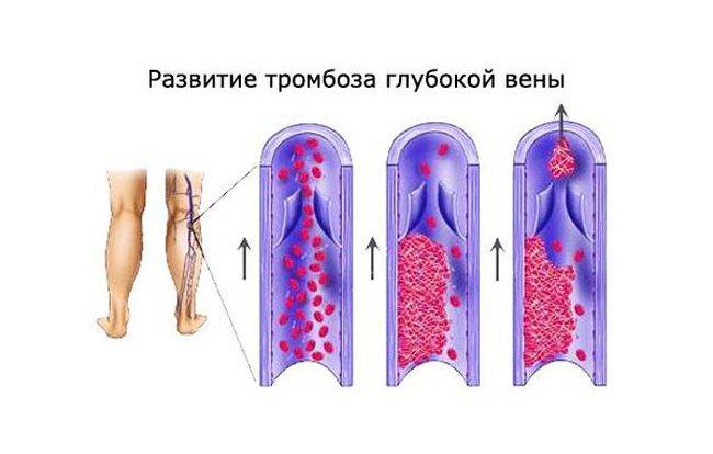 Тромбоз глубоких вен нижних конечностей может возникнуть из-за изменения сворачиваемости и густоты крови Тромбоз глубоких вен нижних конечностей может возникнуть из-за изменения сворачиваемости и густоты крови