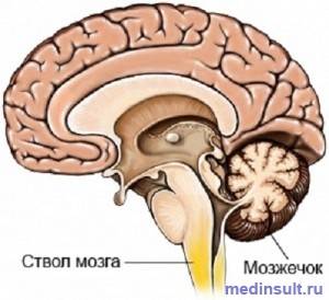 Инсульт ствола головного мозга