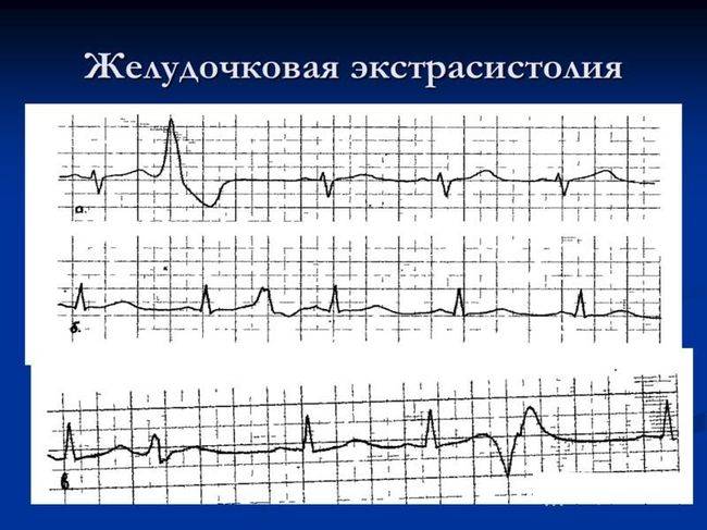 Желудочковая экстрасистолия - это аритмия, возникающая под влиянием нервных импульсов