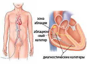 RFA