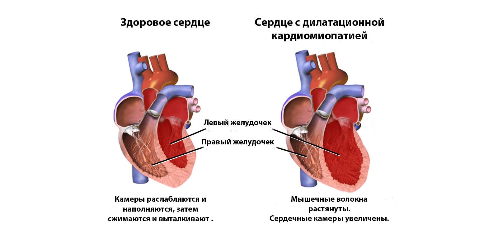 здоровое сердце и с дилатационной кардиомиопатией