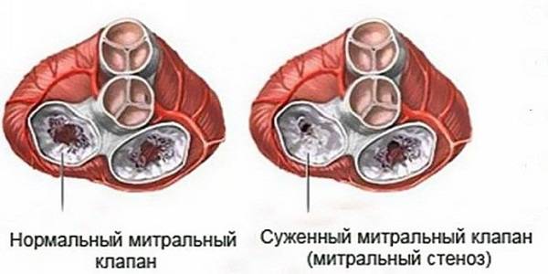 Порок митрального клапана что это такое