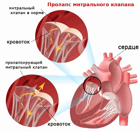 Порок митрального клапана что это такое