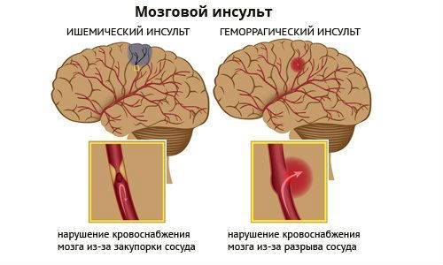 Виды инсульта головного мозга Виды инсульта головного мозга