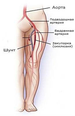 Установка в ногу