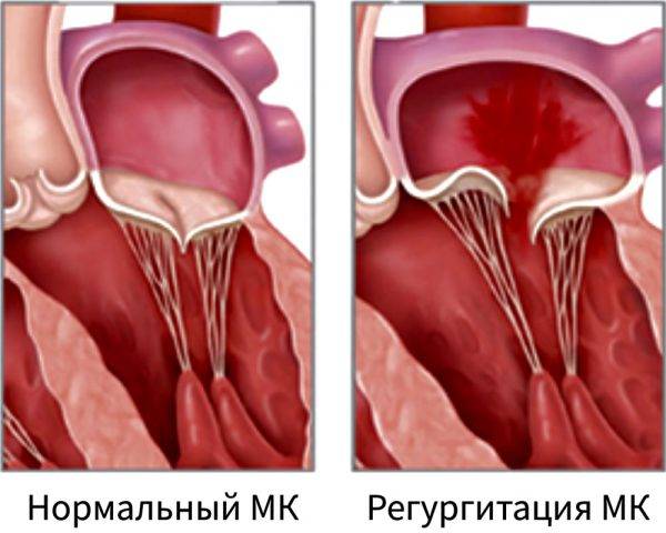 Нормальный и регургитация МК