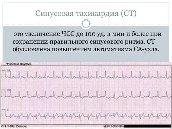 Особенности синусовой тахикардии