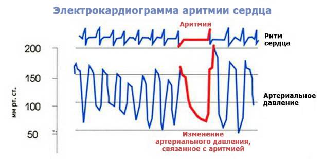 аритмия и алкоголь
