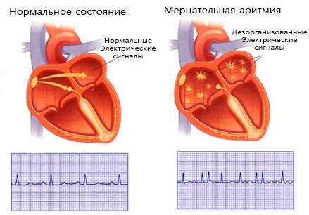 мерцательная аритмия и алкоголь