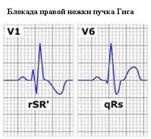 Блокада ножек пучка Гиса