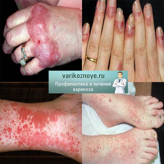 Аллергический васкулит лечение