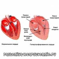 Увеличение сердца, причины, симптомы, лечение, профилактика