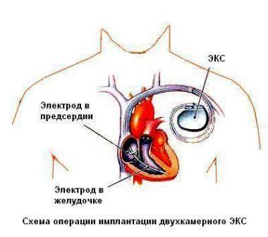 лечение аритмии
