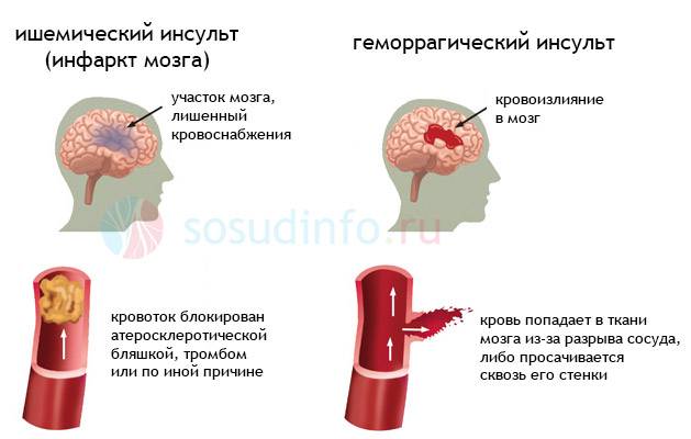 Инсульт: ишемический и геморрагический