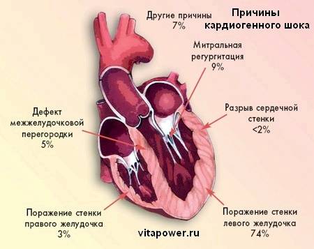 Кардиогенный шок