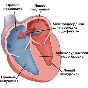 Аневризма МПП