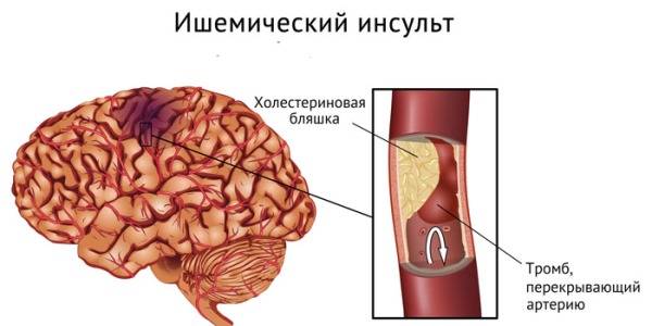 Пример инсульта